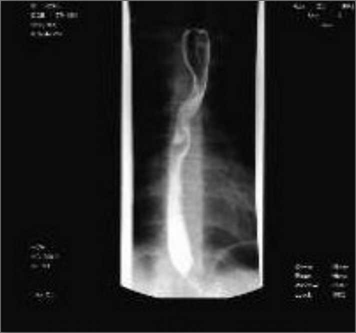 ct oesophagus