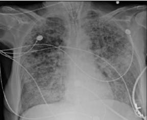 Acute Lung Injury And Acute Respiratory Distress Syndrome A Review Article British Journal Of Medical Practitioners