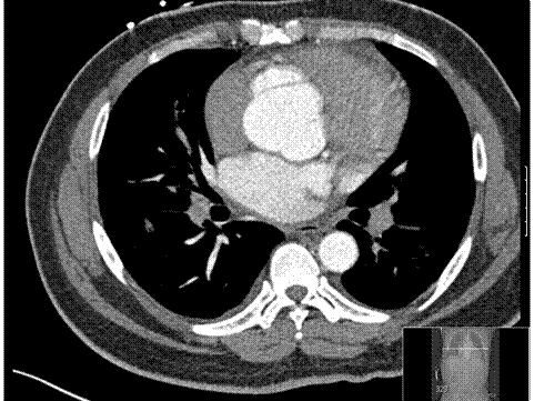 Giant Pubic Lipoma in Normal Individual, Sivrioglu