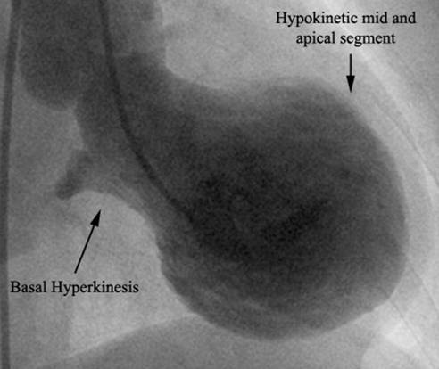 What are some symptoms of takotsubo cardiomyopathy?