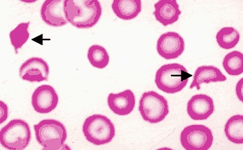 thrombotic thrombocytopenic purpura smear