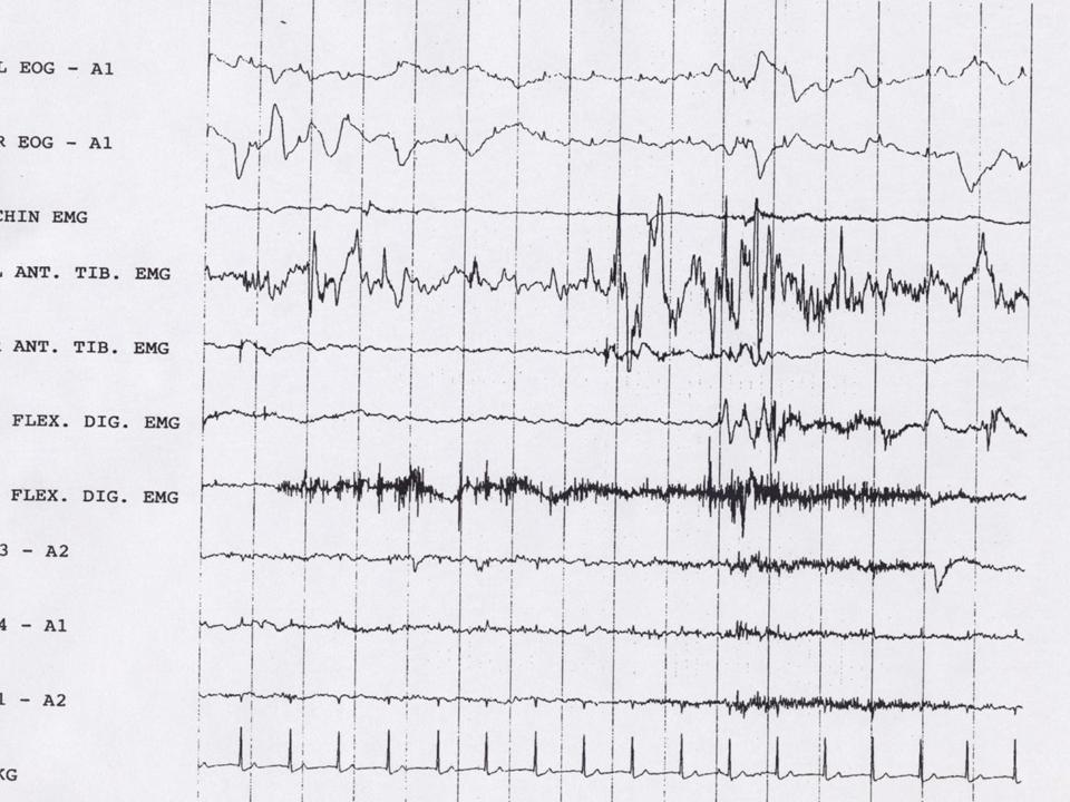 REM Behavior Disorder (RBD) as an Early Marker for Development of