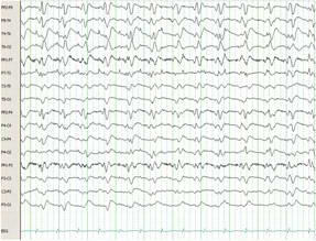 CMAJ on X: Postural orthostatic tachycardia syndrome (POTS) is a chronic,  multi-system disorder that mainly affects girls and young women, and can  lead to functional impairment. Learn more (and earn CPD credits)