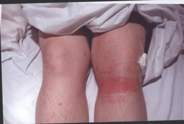 guttate psoriasis