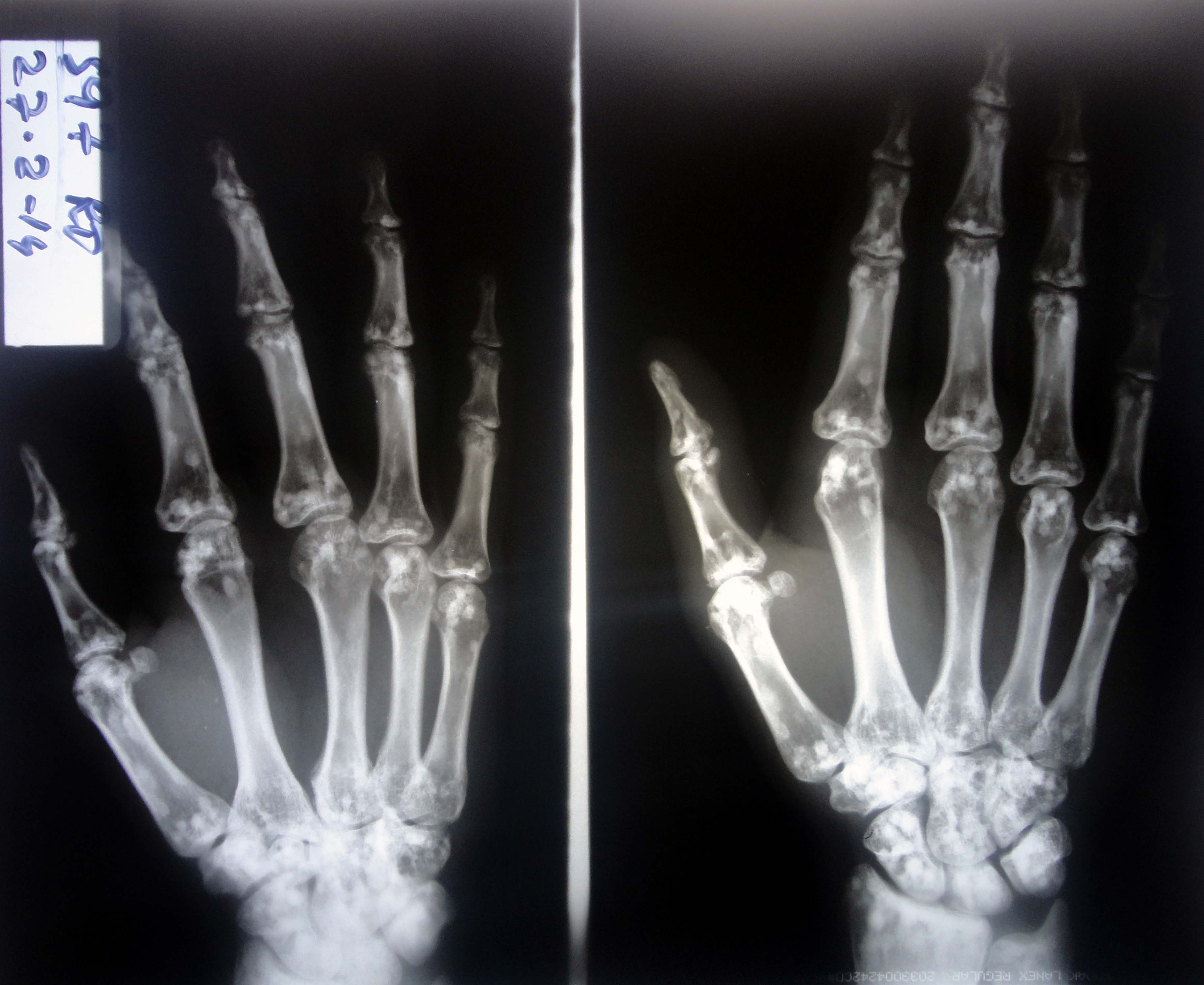 bones of the hand x ray