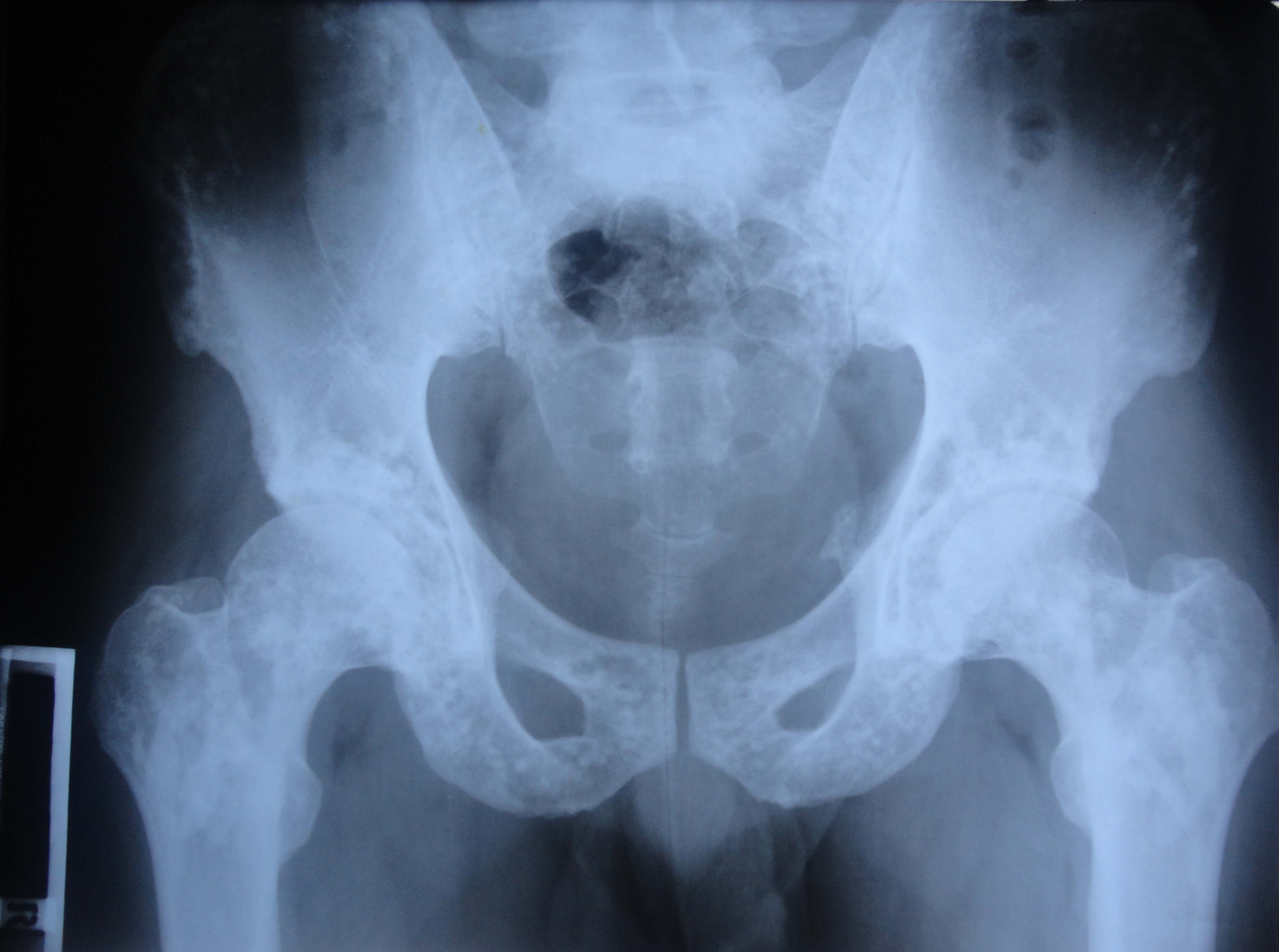 spotted-bone-a-spot-diagnosis-british-journal-of-medical-practitioners