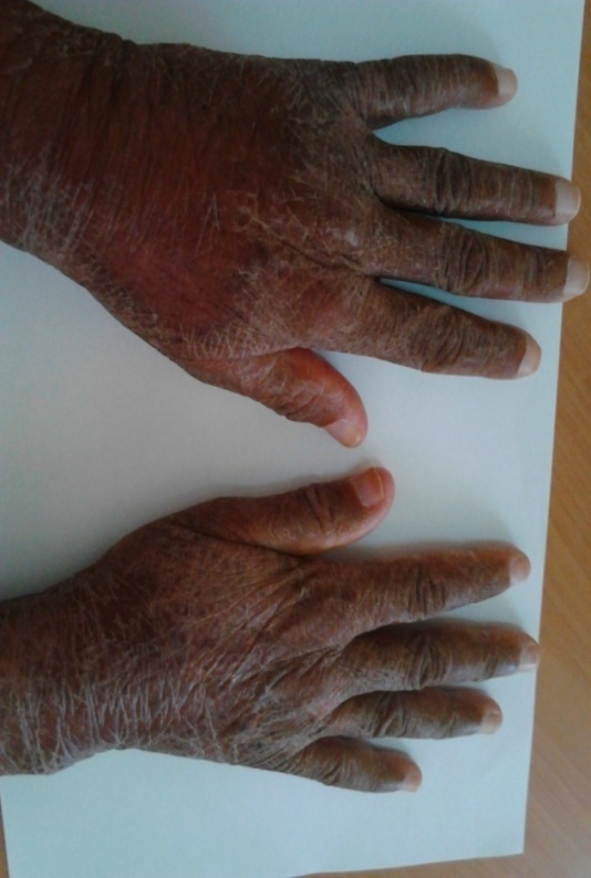 pellagra hands