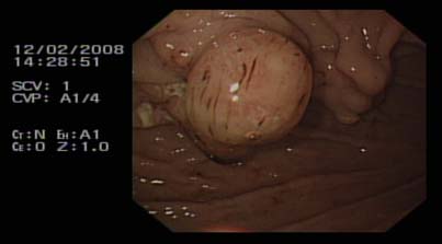 Laparoscopic pictures of the fibrinous adhesion, dark brownish ascetic