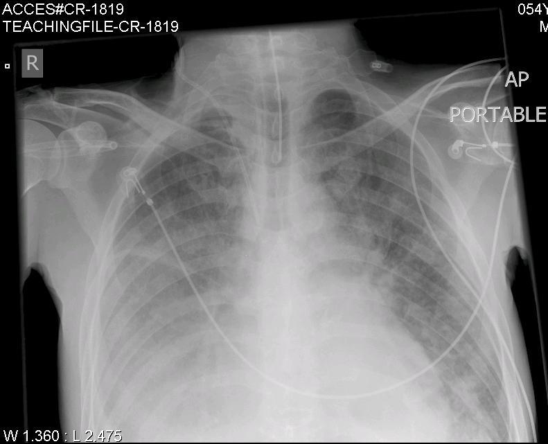 carina lung xray