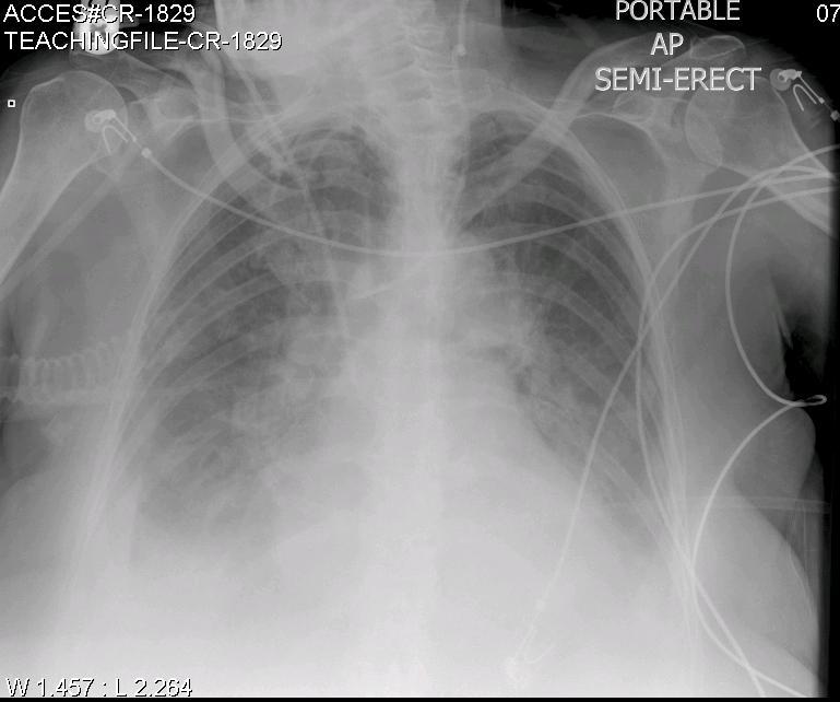 hickman catheter x ray