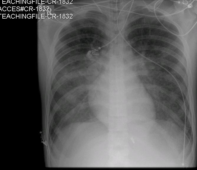 hickman catheter x ray