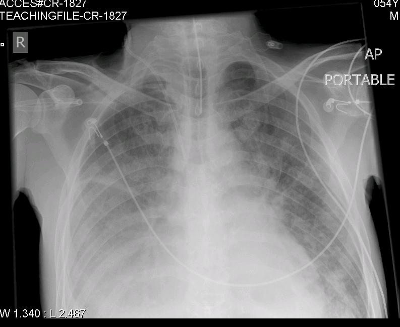 endotracheal tube placement x ray