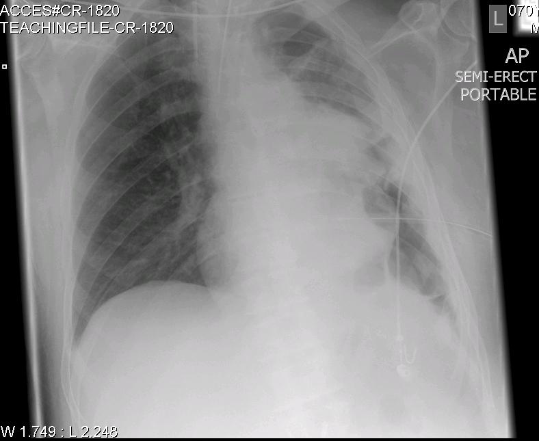 endotracheal tube placement x ray